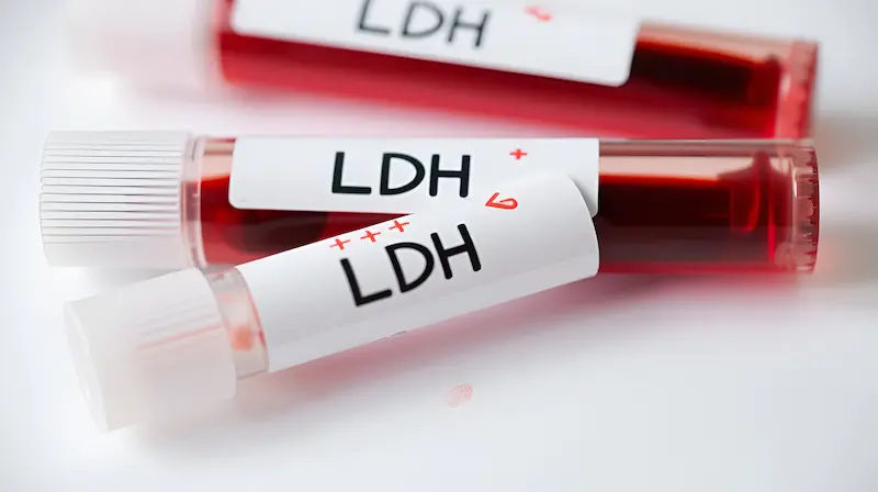 Lactate Dehydrogenase Test Overview and Procedure